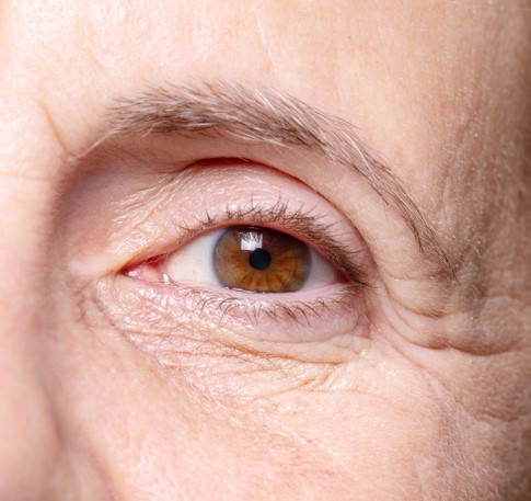 Crow&rsquo;s feet lines at the outer eye before Botox