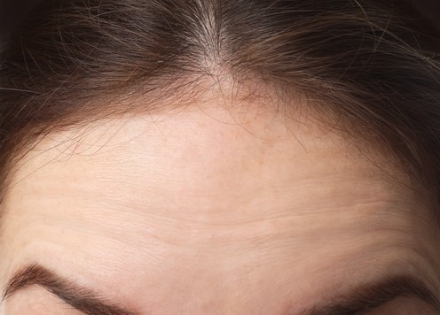 Smoother forehead about two weeks after Botox in St. Petersburg