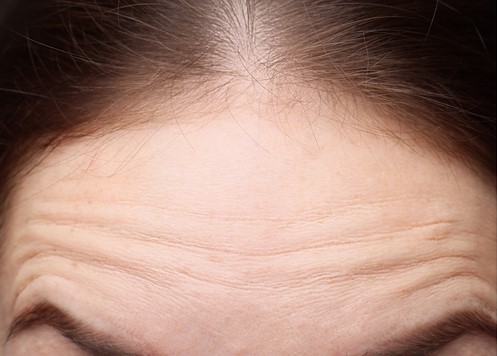 Horizontal forehead lines before Botox treatment