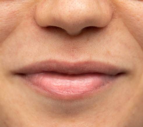 Upper lip with a subtle roll after a Botox lip flip in St. Pete